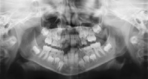 Teeth X-Rays